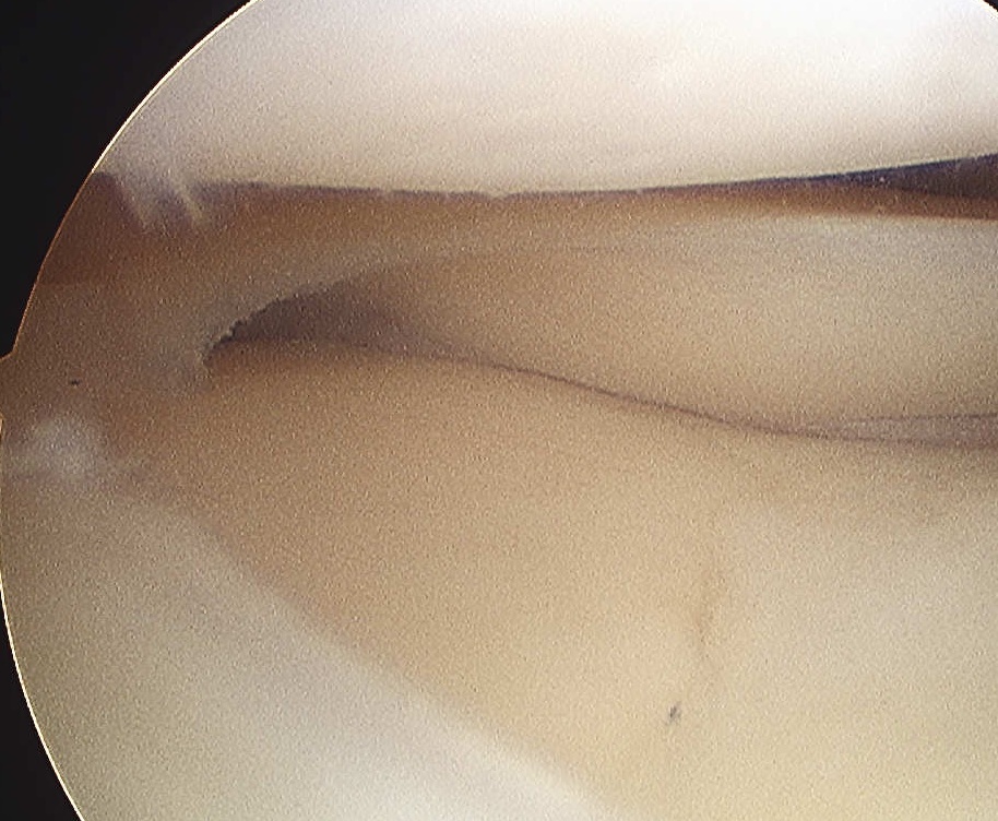 Lateral Meniscus Cyst Normal Looking Meniscus